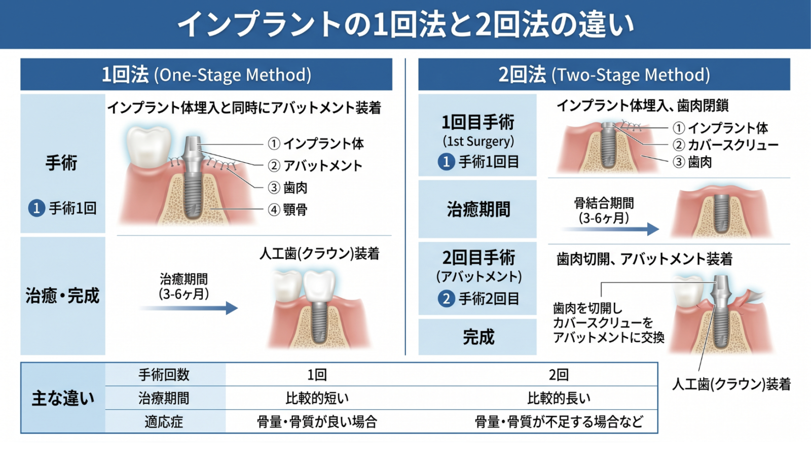 松山市のインプラント治療1回法と2回法の比較イメージ