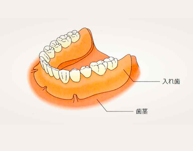 従来の治療法：総入れ歯